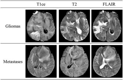 M3: using mask-attention and multi-scale for multi-modal brain MRI classification